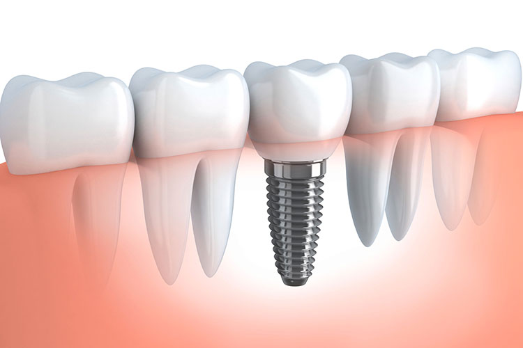 implantologia studio-dentistico-monteceneri